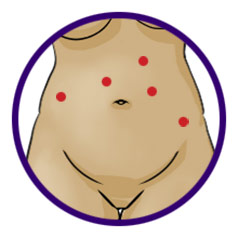 Robotic Surgery Scars