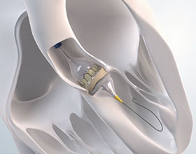 Transcatheter Aortic Valve Replacement