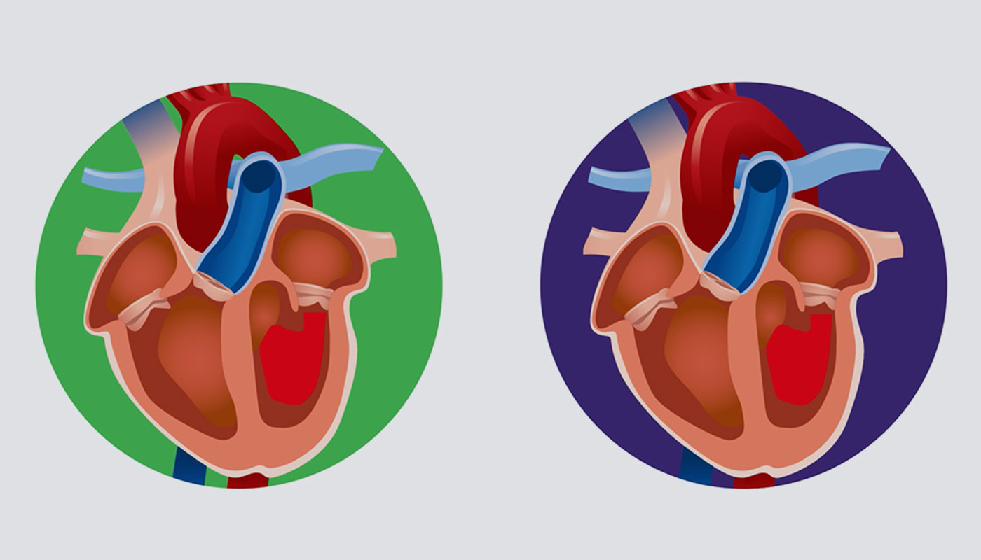 Heart Valve Disease video