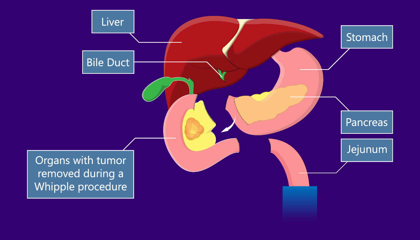 Whipple procedure (pancreaticoduodenectomy) - Step-2