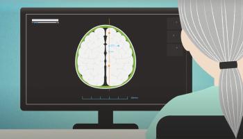 Before the Focused Ultrasound Treatment video